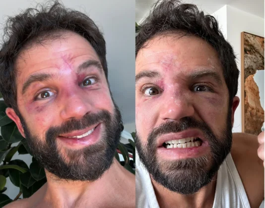 Ap&oacute;s luta com Pop&oacute;, Duda Nagle relata dificuldades at&eacute; para entrar na academia: "Nem a catraca me reconheceu" (Foto: Instagram)